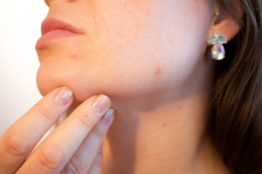 Acnes White