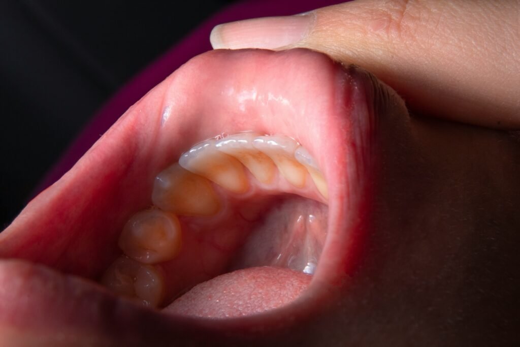 how to get rid of gum infection without antibiotics