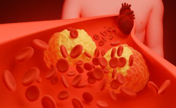 Can Ozempic Cause Blood Clots